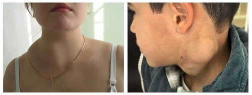 Hodgkin's lymphoma, what is the disease, symptoms and stages, how long do patients live?